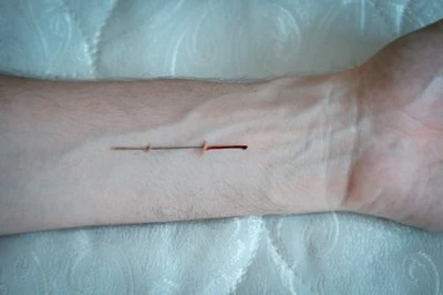 Laparoscopy Shaver Blades: Daim Ntawv Thov Kev Kho Mob